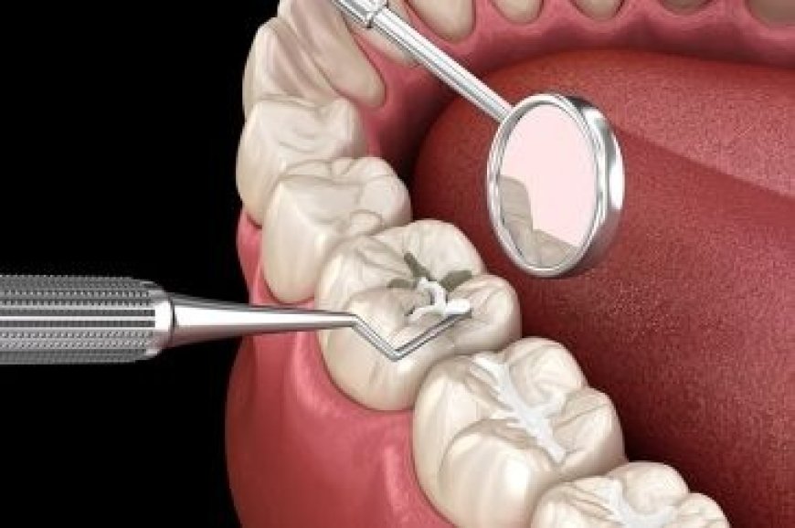 Preventing Tooth Decay: The Role of Tooth Fillings in Dental Health in Dubai