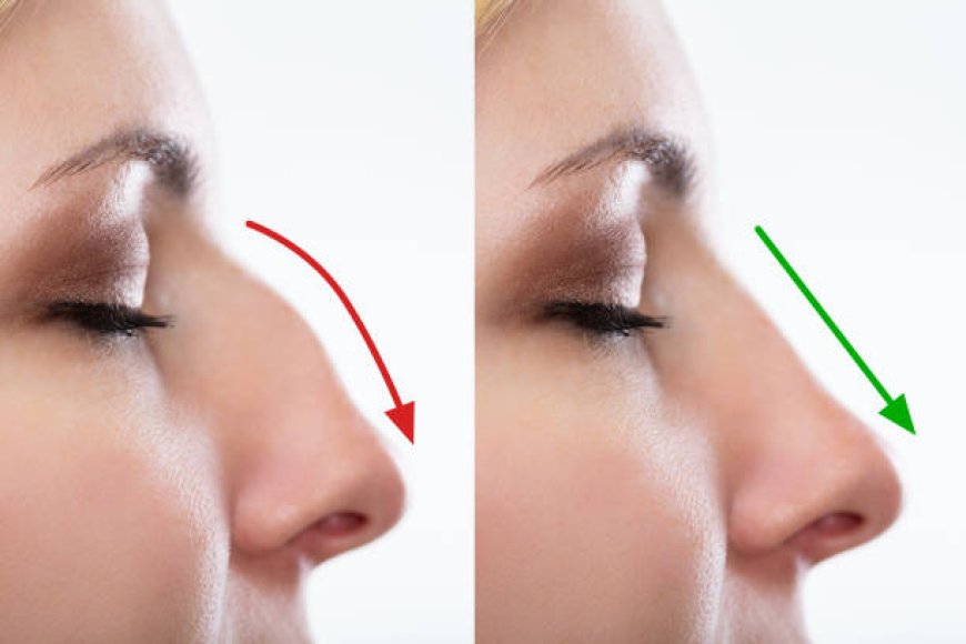 Rhinoplasty in Dubai: Costs, Surgeons & Results 2024