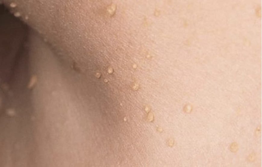 Common Myths About Skin Tag Removal Debunked: Expert Opinions from Dubai