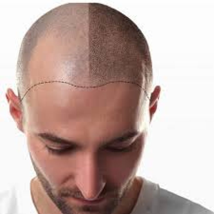 Your Complete Hair Transplant Journey in Riyadh