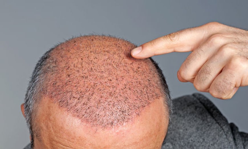 Investing in Your Hair: Understanding the Financials of Dubai Hair Transplants