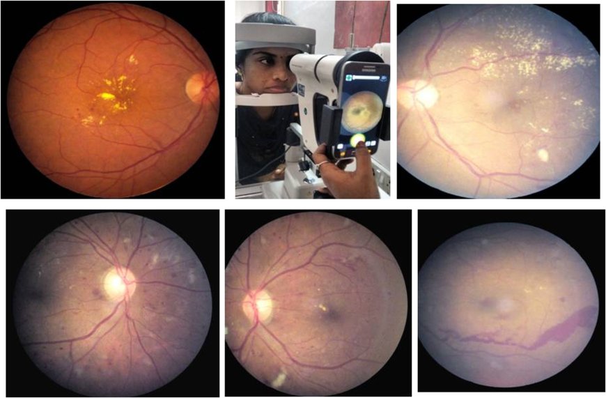 AI in Diabetic Retinopathy Market  Analysis, Size, Share, Growth, Trends Forecasts 2023-2030