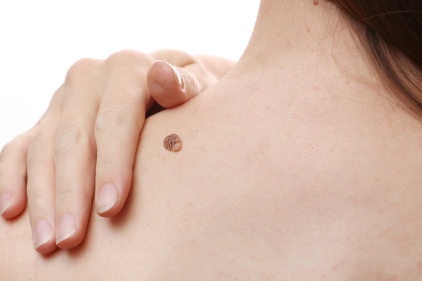 Skin Tag Removal for Sensitive Areas: Safe Solutions in Dubai