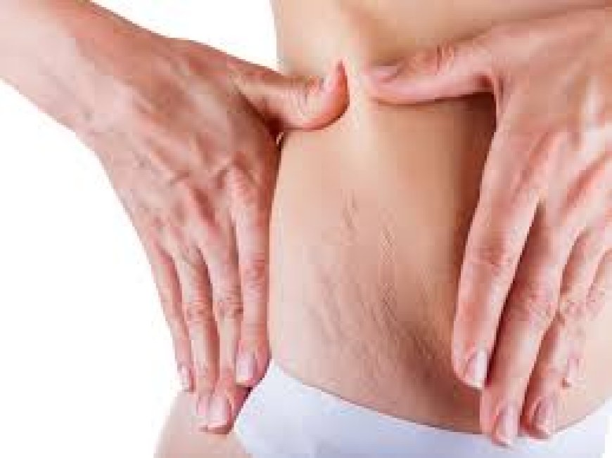 Is Laser Stretch Marks Treatment in Dubai Suitable for Pregnant Women