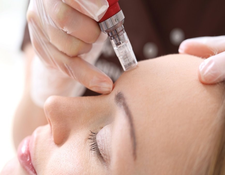 Get the Glow: Mesotherapy for Skin Brightening in Dubai