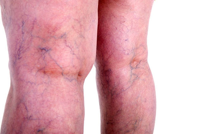 Transform Your Legs with Spider Veins Treatment in Abu Dhabi