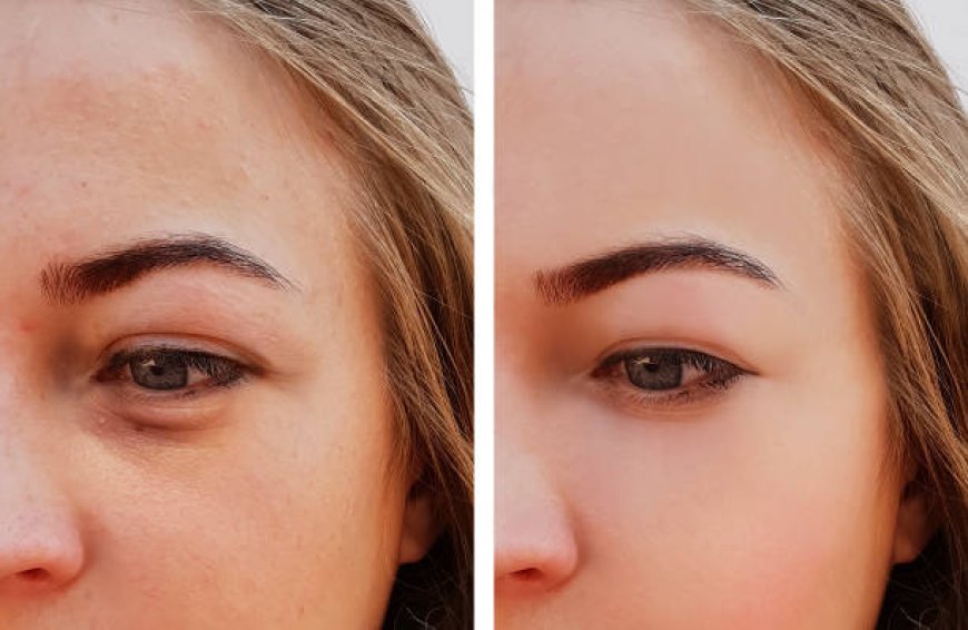 Eye Bag Removal in Abu Dhabi: Fast and Effective Under-Eye Treatment