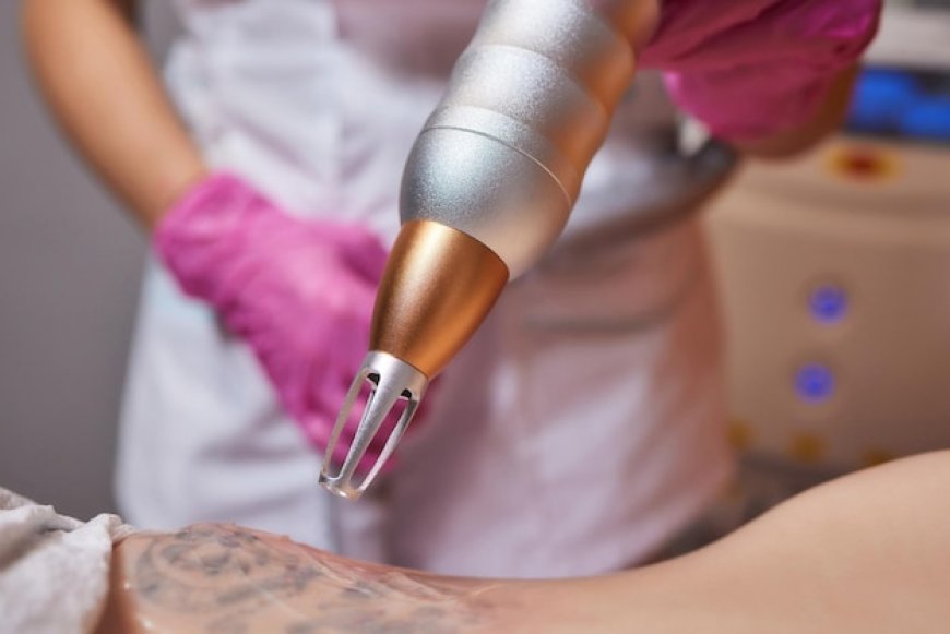 Erase Ink with Precision Laser Tattoo Removal