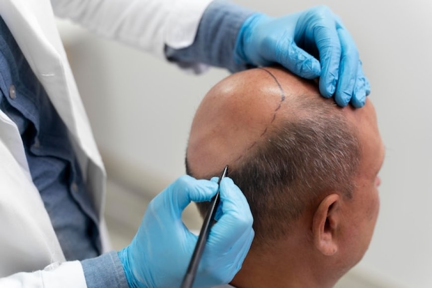 Transform Your Look with Scalp Micropigmentation