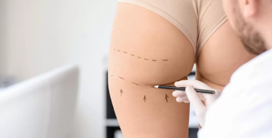 Butt Fat Transfer Vs Implants in Dubai Which Is the Better Option