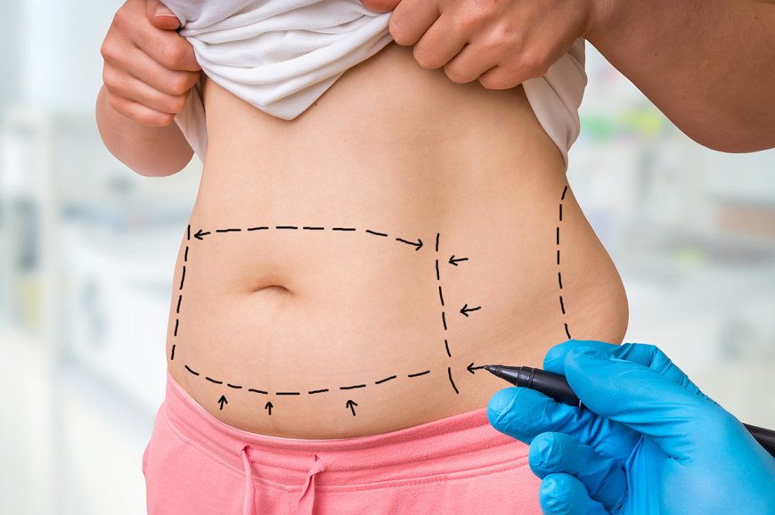 Liposuction Surgery in Dubai: The Ultimate Patient Guide