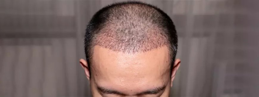 Hair Transplant Packages in Dubai: What’s Included?