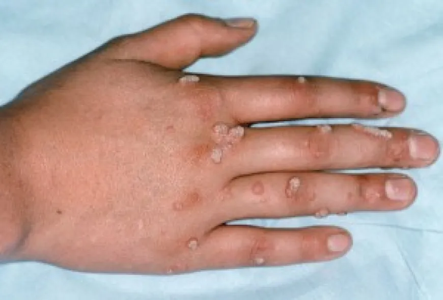 The Role of Immune System in Warts Formation and Removal in Islamabad