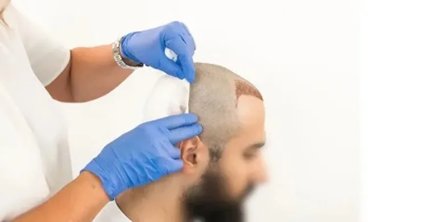 How to Manage Hair Transplant Cost in 2024