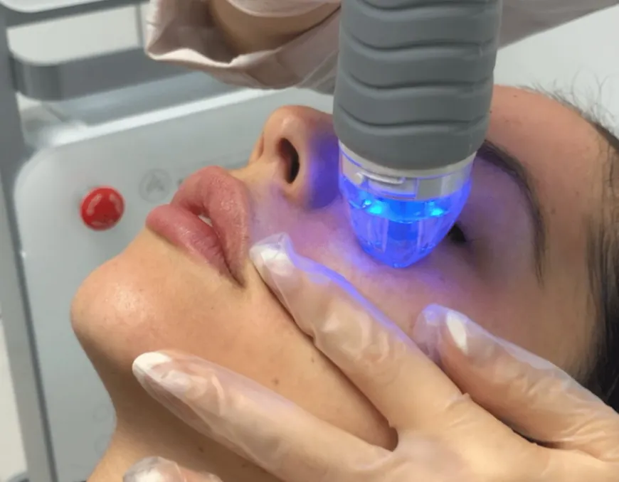 Fractional RF Microneedling for Skin Pigmentation: A Dubai Solution