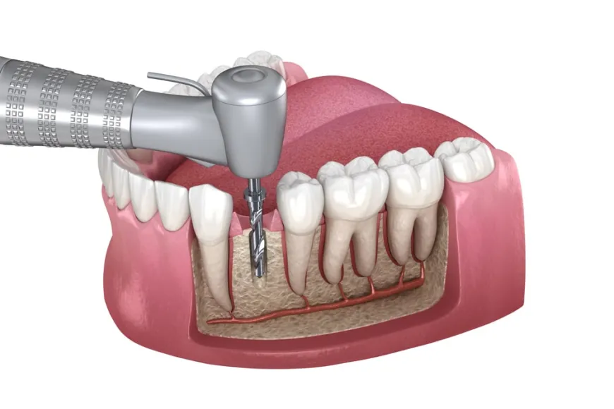 Why Andheri West is the Go-To Location for Root Canal Treatment