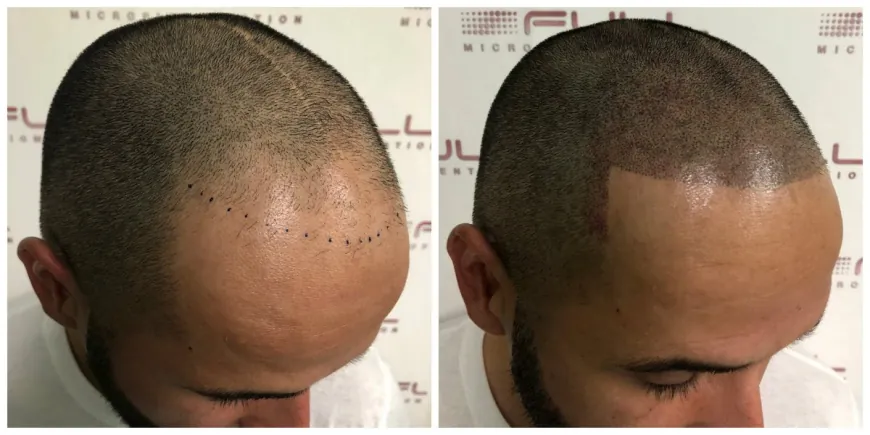 The Ultimate Solution for Thinning Hair and Confidence Restoration