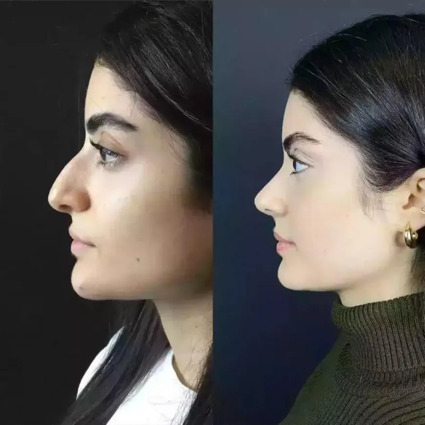 Best Rhinoplasty Surgeons in Dubai: Your Guide to Top-Rated Experts for Perfect Nose Reshaping