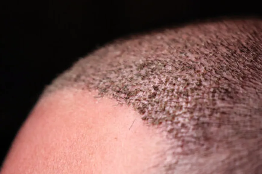 FUE Hair Transplant: The Confidence Boost You Deserve