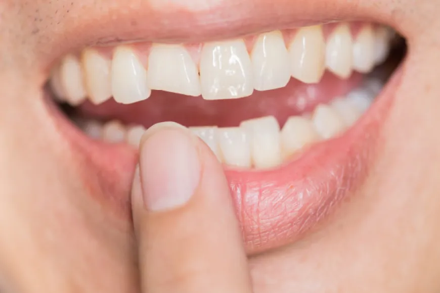 Whiten Your Way to Confidence: Exploring Teeth Whitening Techniques