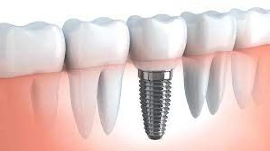 Dental Implants Everything You Need to Know