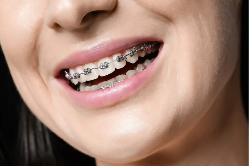 Teeth Braces Everything You Need to Know Before Getting Started