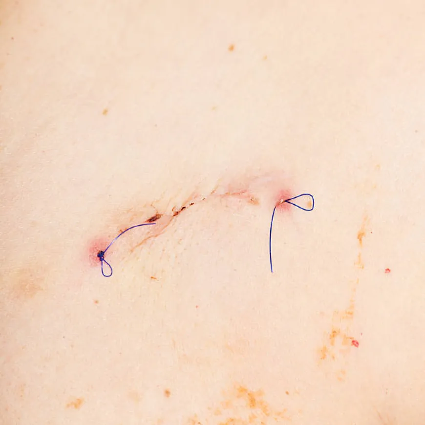 Transform Your Look with Surgical Scar Revision