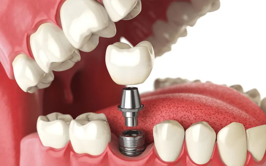 The Future of Dental Restoration: Exploring Dental Implants