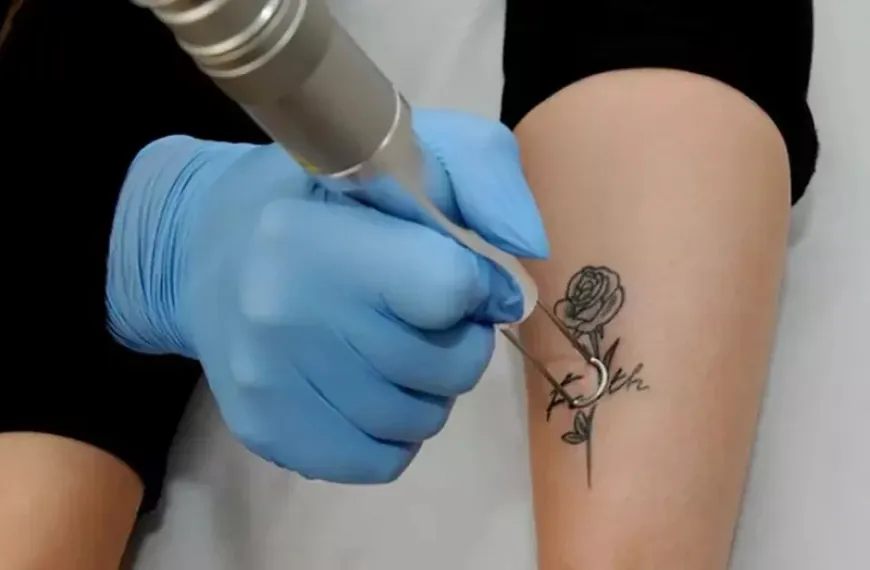 Comprehensive Guide to Laser Tattoo Removal in Dubai