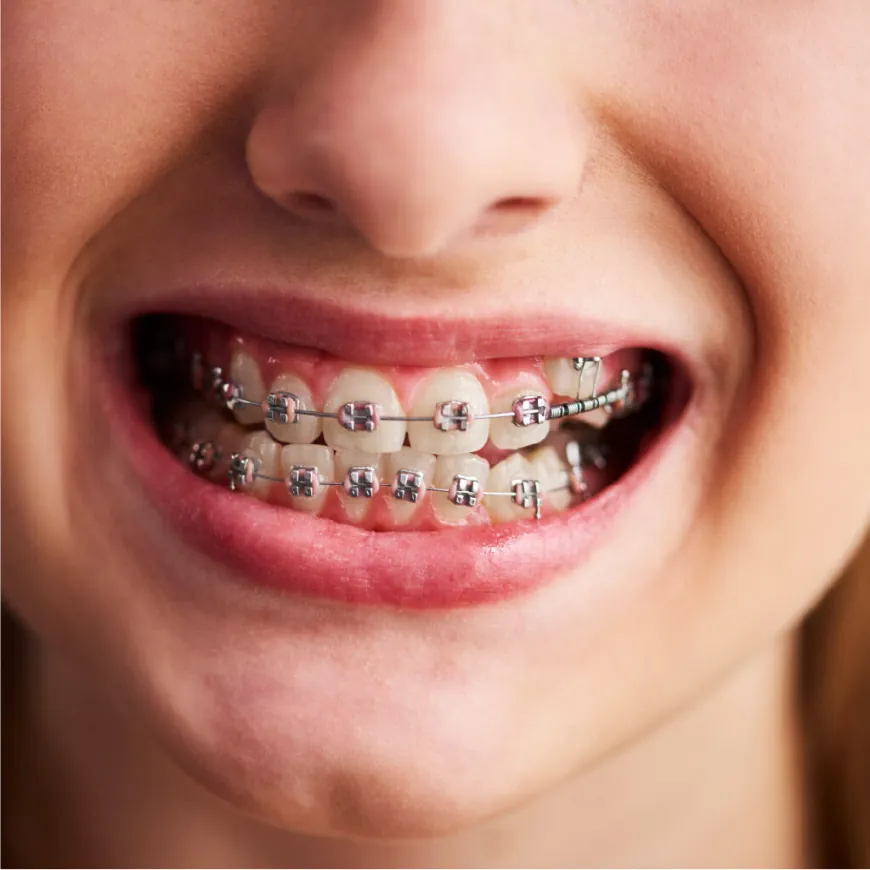 Embrace Change with Metal Braces for Your Smile