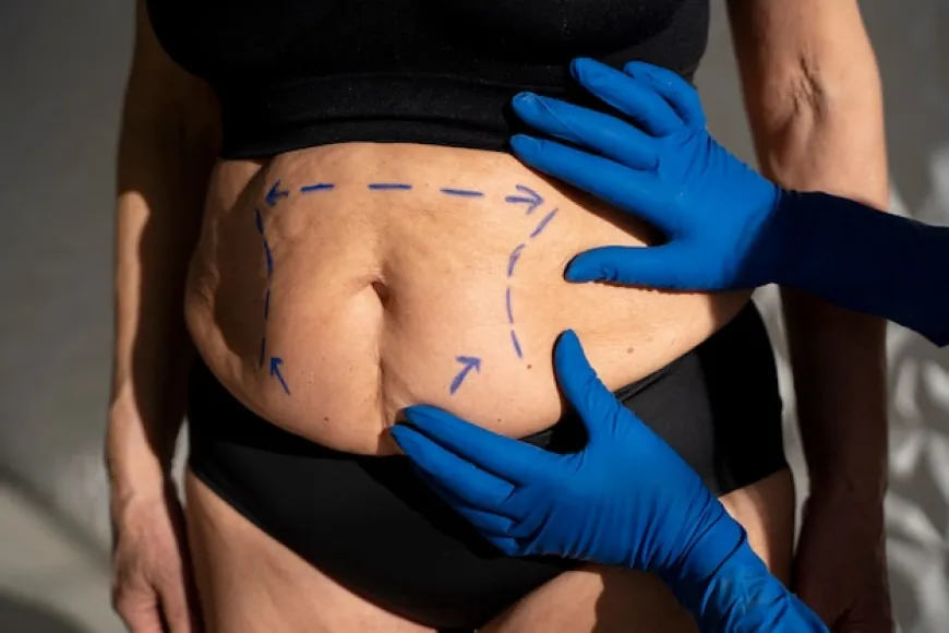 Liposuction: Your Answer to a Sculpted Figure