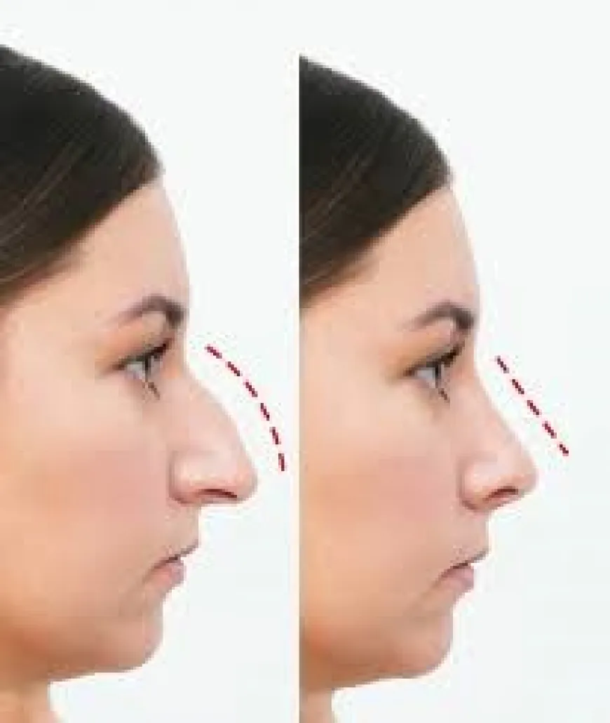 What is the Ideal Nose Shape? Understanding Rhinoplasty in Dubai