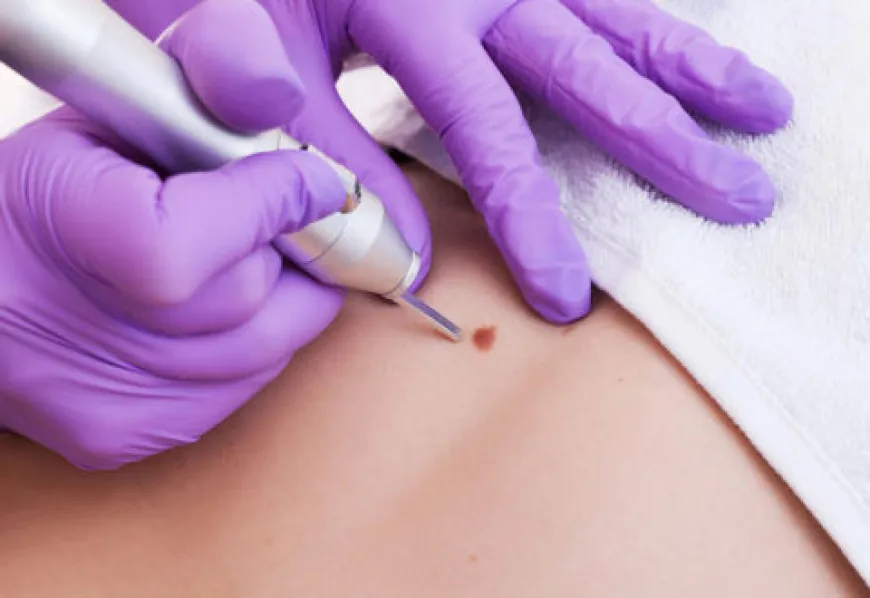 What Causes Skin Tags and How to Prevent Them in Dubai