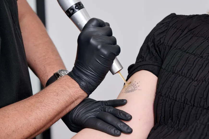 What to Expect During Your First Laser Tattoo Removal Session