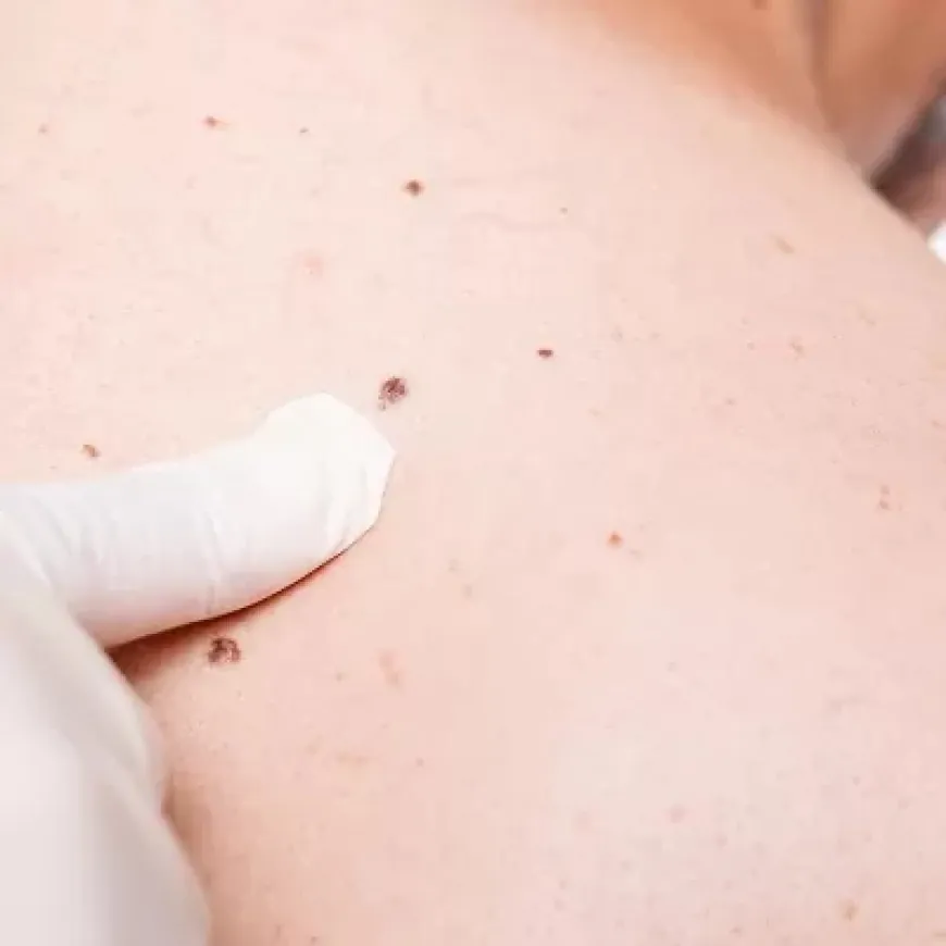 Natural Remedies for Skin Tag Removal You Can Use