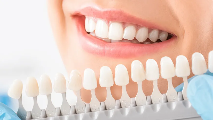 Before and After Composite Veneers: A Guide to Smile Enhancement