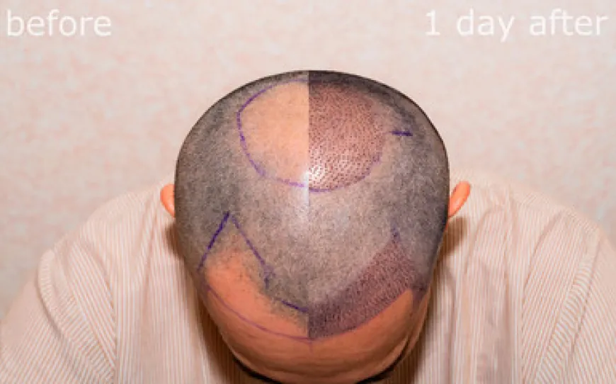 Top Reasons to Choose Want Hair Ltd for Your Hair Transplant in Istanbul