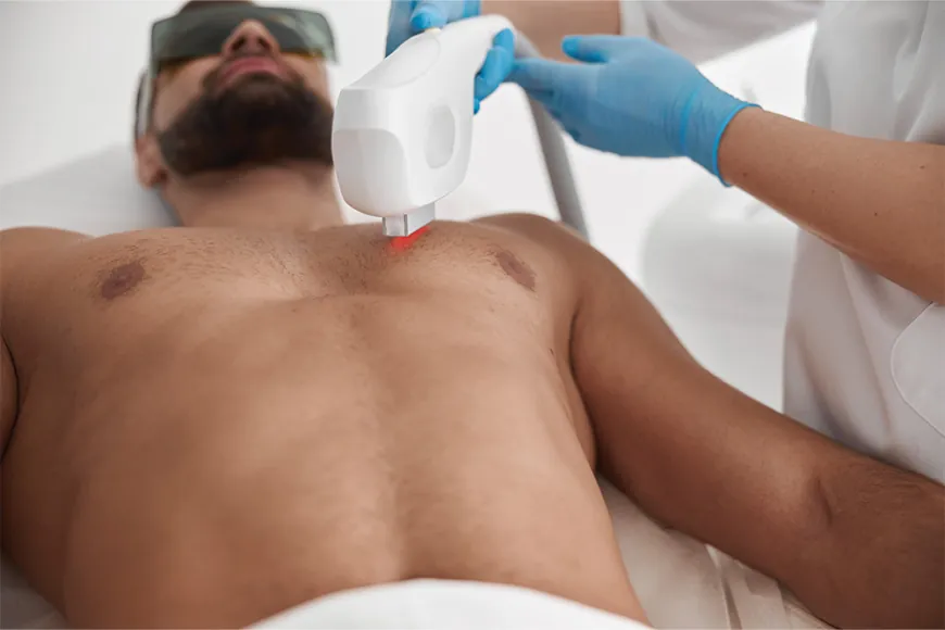 Laser Hair Removal for Long-Lasting Smooth Skin