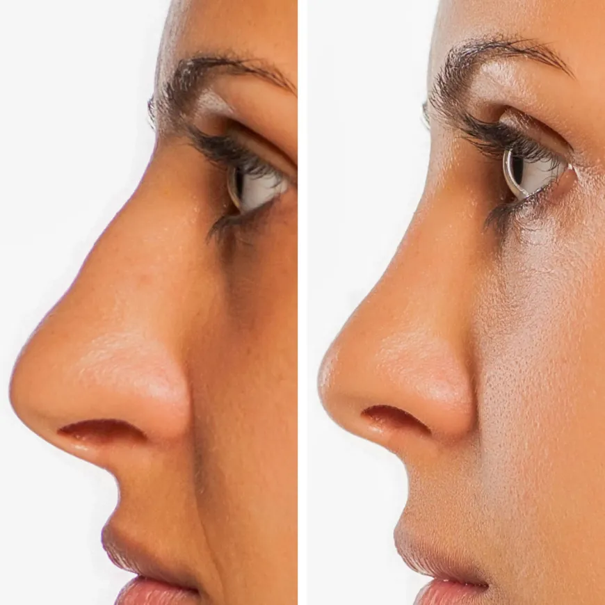 What to Expect During Your Rhinoplasty Consultation in Dubai