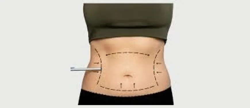 Revolutionize Your Body with Liposuction in Dubai