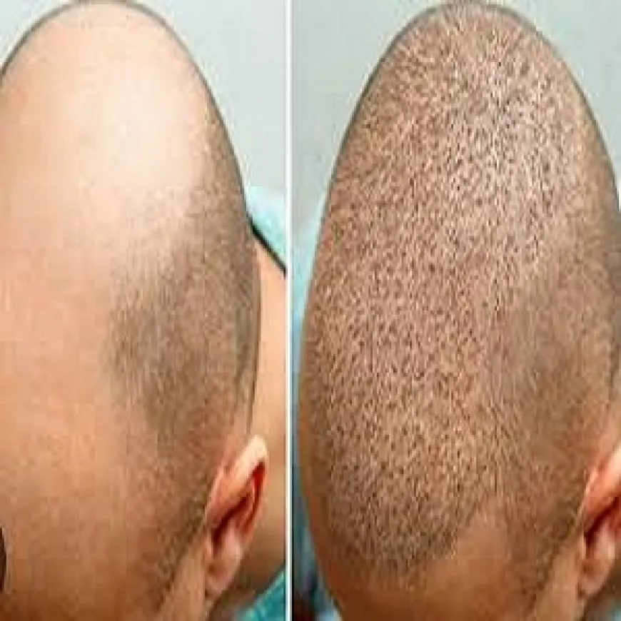 Achieve Your Hair Goals with Riyadh’s Expert Hair Transplant Specialists