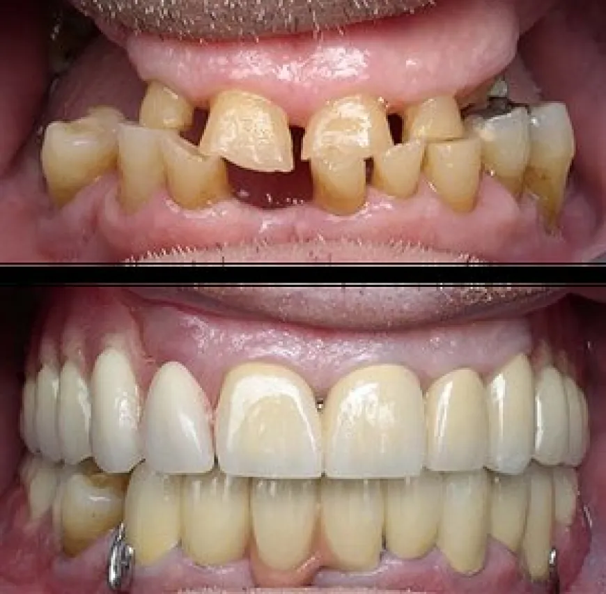 Full Mouth Restoration vs. Cosmetic Dentistry: Which is Right for You?