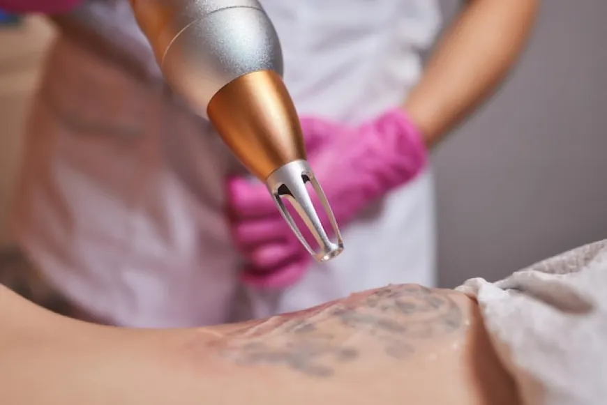 Exploring Laser Tattoo Removal: Your Ultimate Guide!