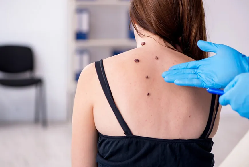 Do skin tags spread?