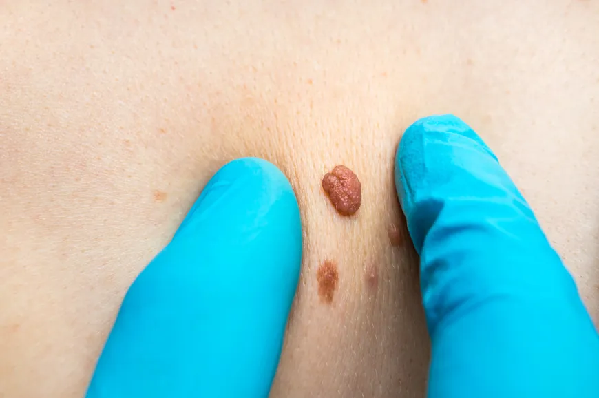 How do I remove skin tags at home?