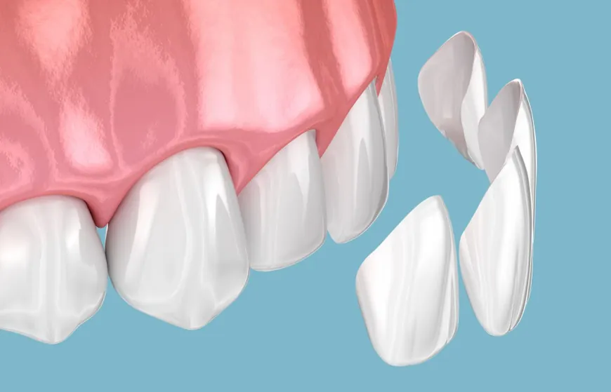 Composite Veneers: The Perfect Addition to Your Dental Routine