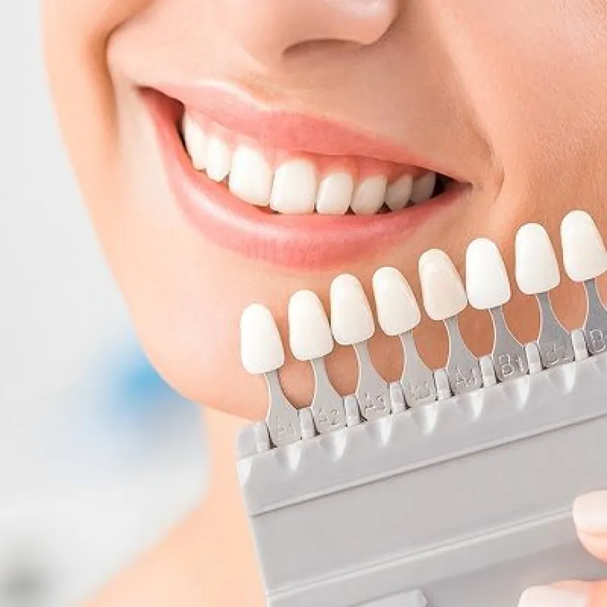 Dental Veneers in Dubai: The Ultimate Smile Solution