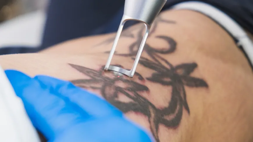 Laser Tattoo Removal: Dubai’s Top Tips for Faster Healing