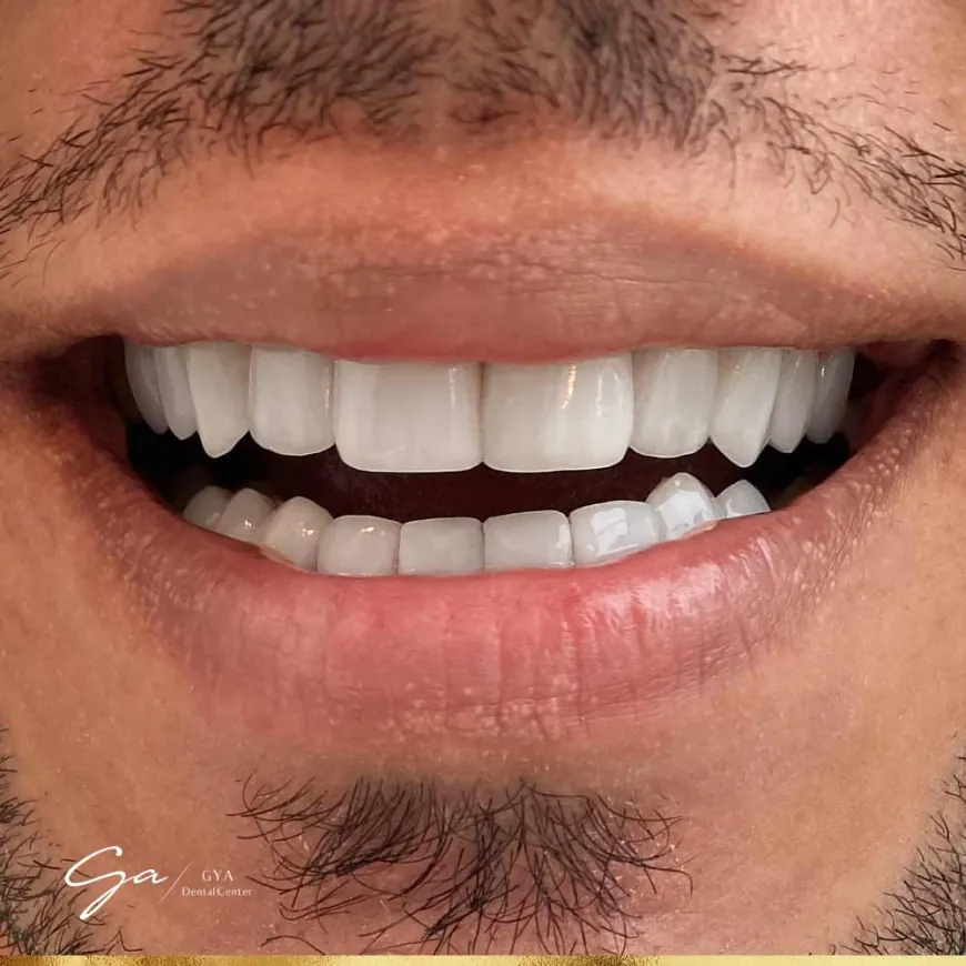 Dental Veneers: Your Smile's Best Friend