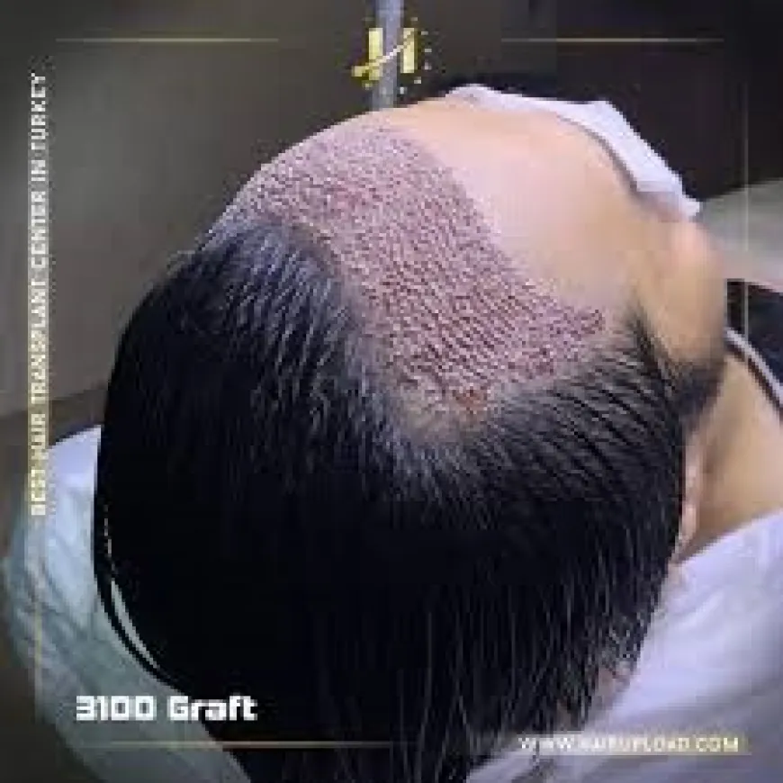 Hair Transplant in Riyadh: What You Need to Know